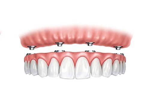 Implant - Stabilized Overdentures