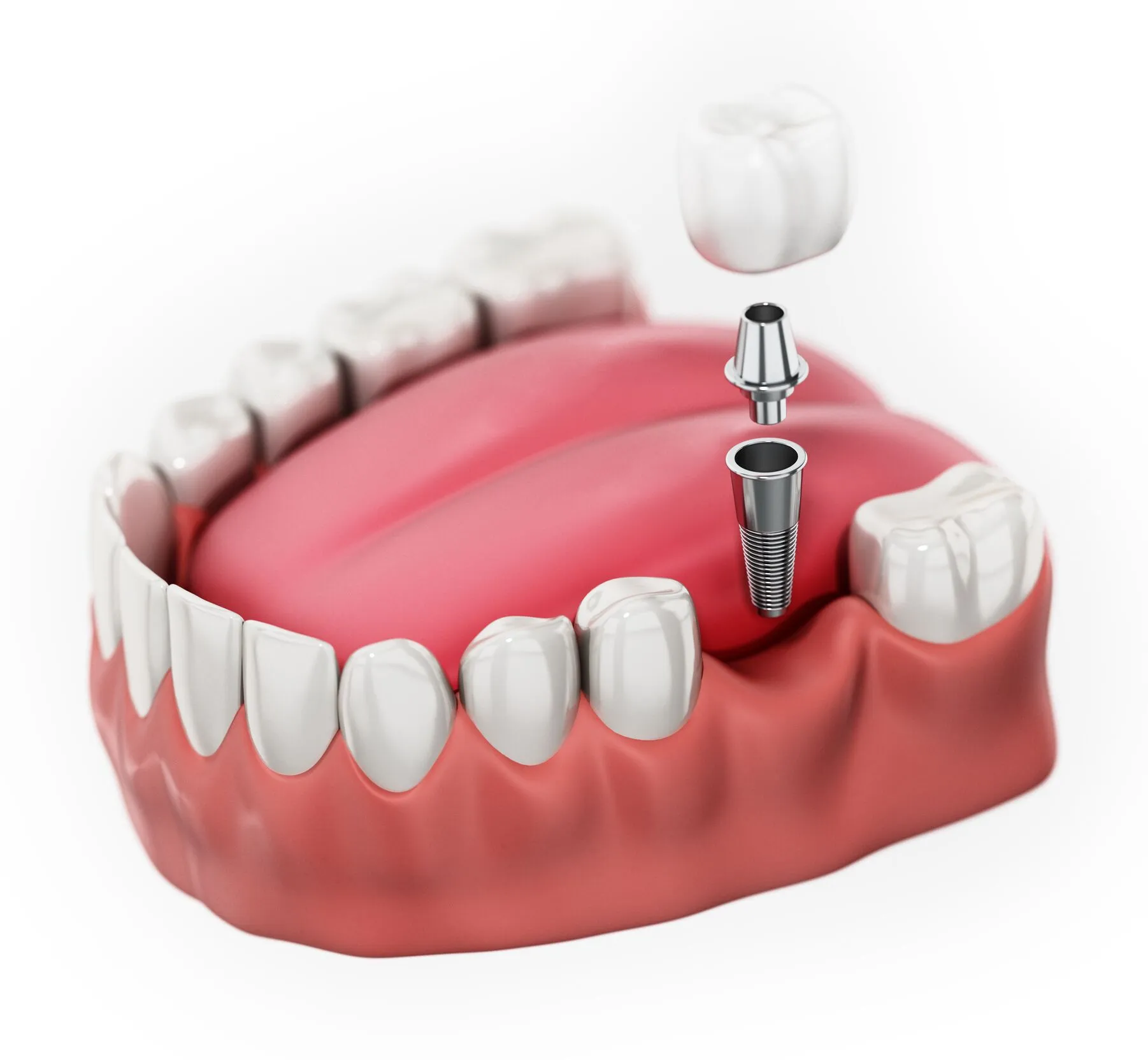 Single Implant