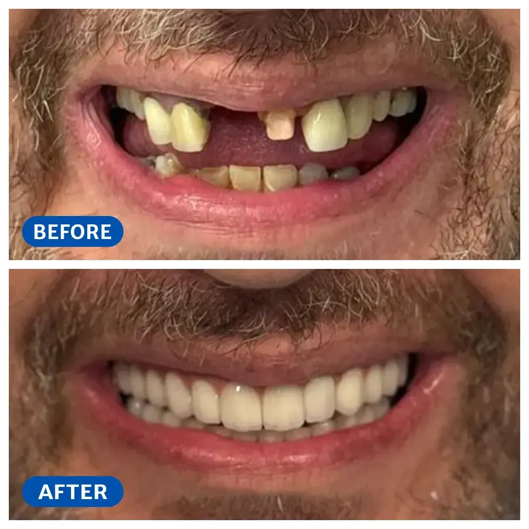 Smile transformation 1